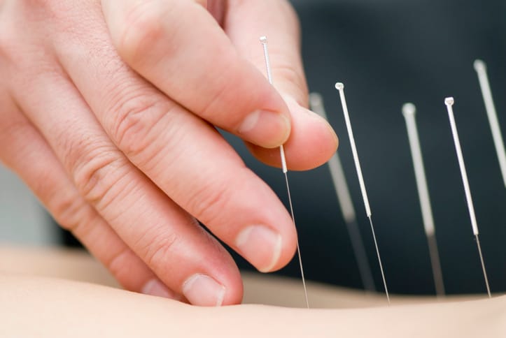 Keast Mews Dental provide dental acupuncture